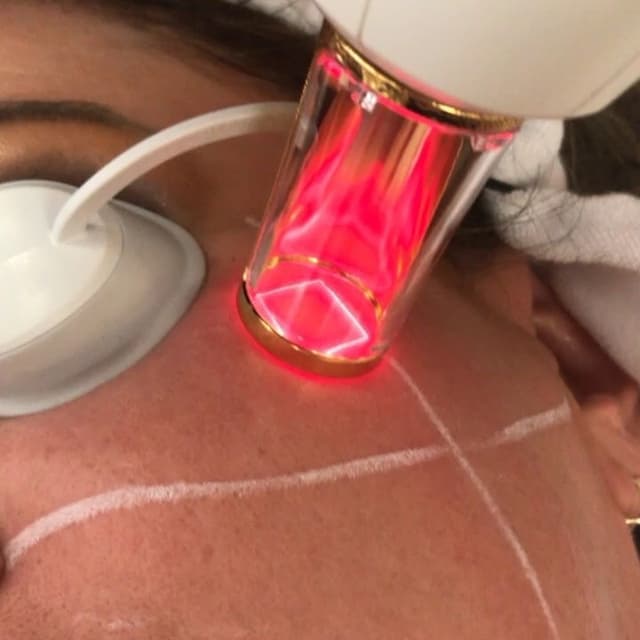 RINOVARE FRAXEL LASER at Lavana by Remake in Edinburg, TX